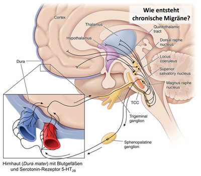 chronische Migräne